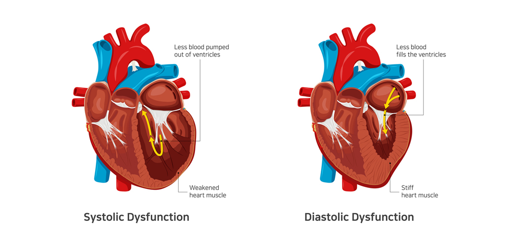 Types Of Heart Failure Diastolic Vs Systolic Dr Raghu