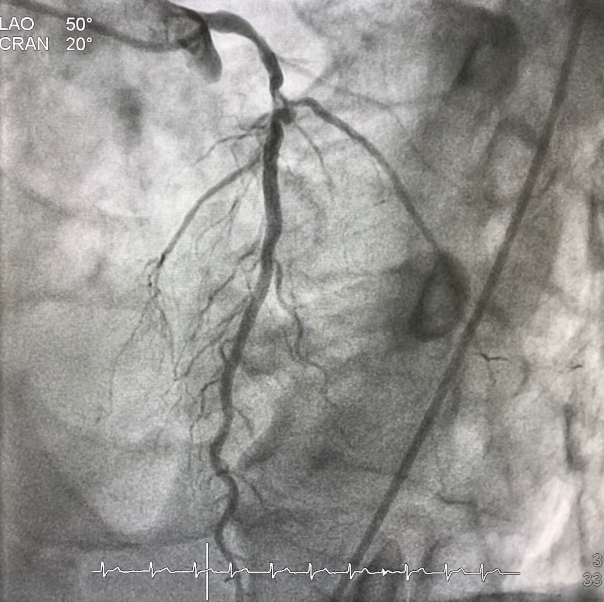 Bifurcation-lesion-on-coronary-angiography-1200x1197.jpg