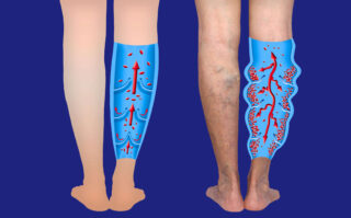 Varicose Veins