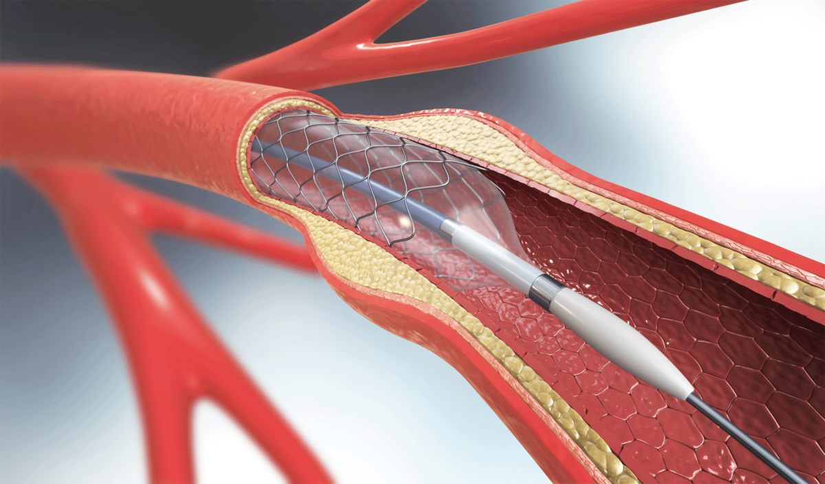 angioplasty compresses plaque