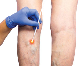 Endovenous Ablation for Varicose Veins