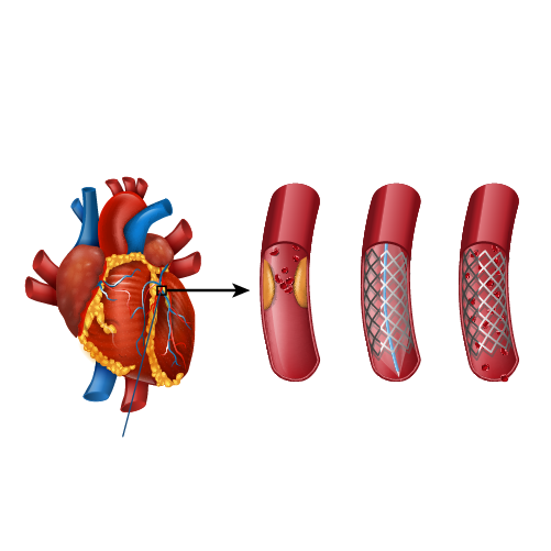 coronary angioplasty