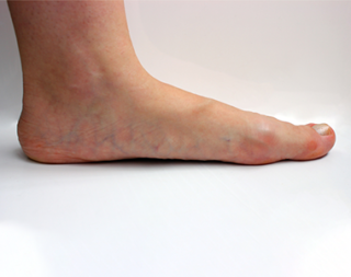 critical limb ischemia