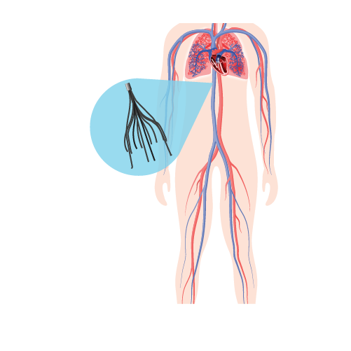 Inferior Vena Cava (IVC) Filter Dr Raghu