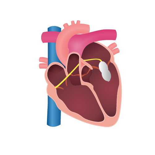 Common Cardiac Interventions DrCRaghu