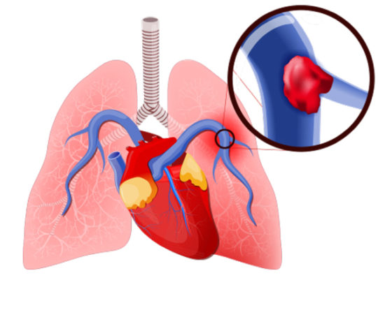 Pulmonary Embolism Signs Dr Raghu