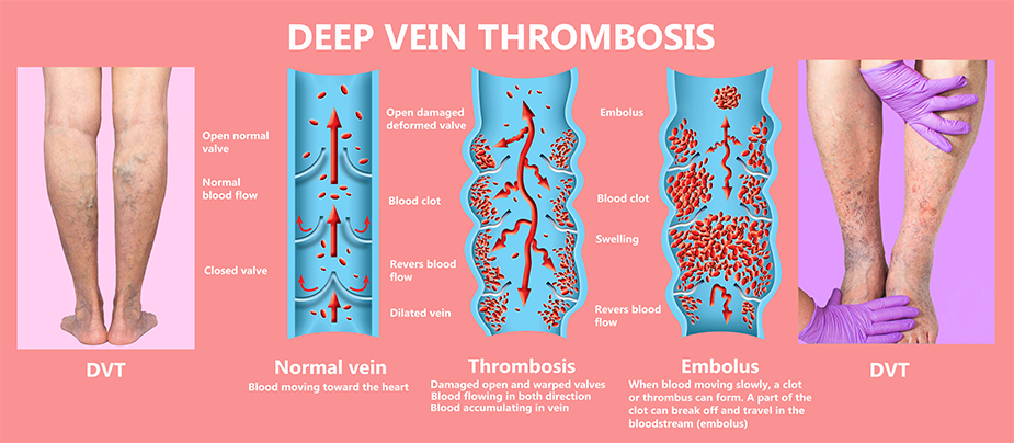 Deep Vein Thrombosis DVT Treatment Dr C Raghu