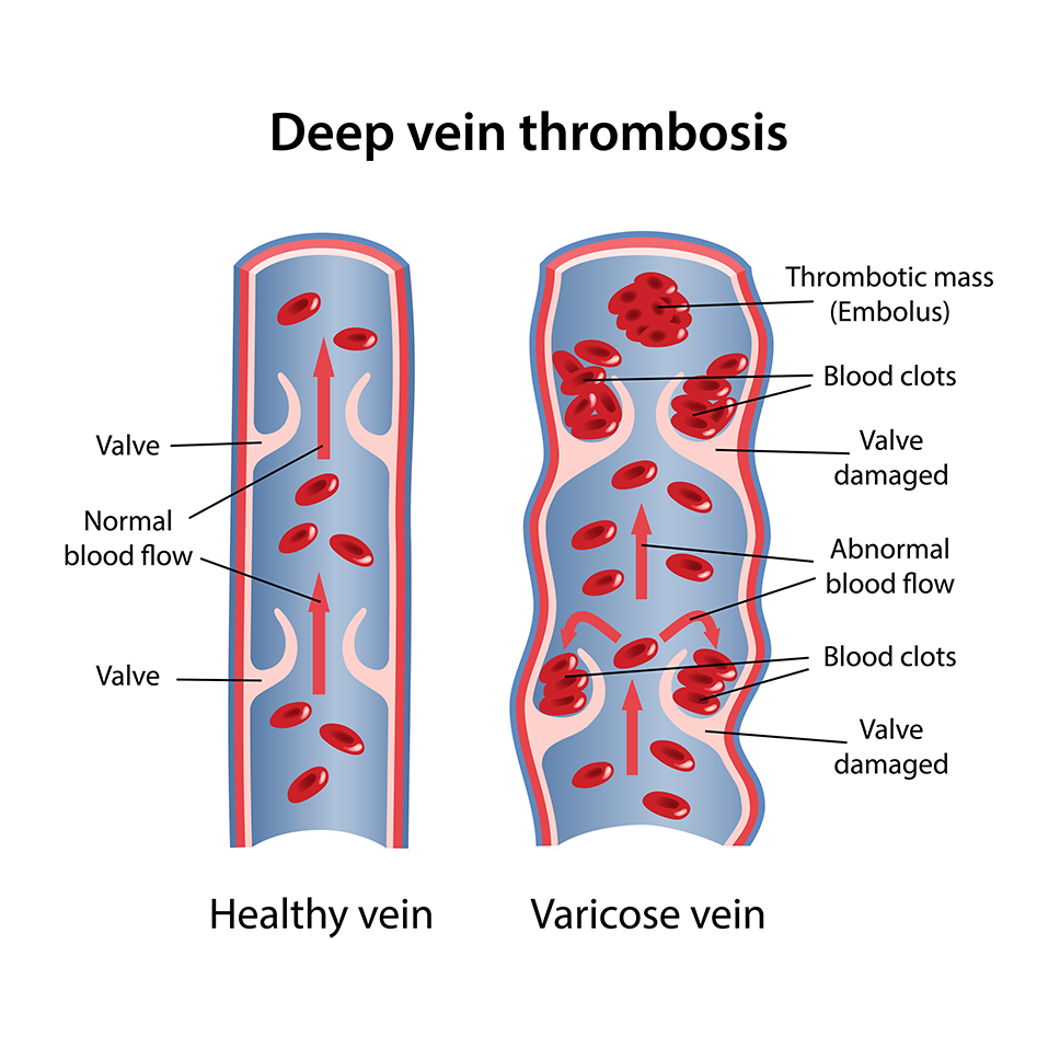 Healthy vein vs Varicose vein