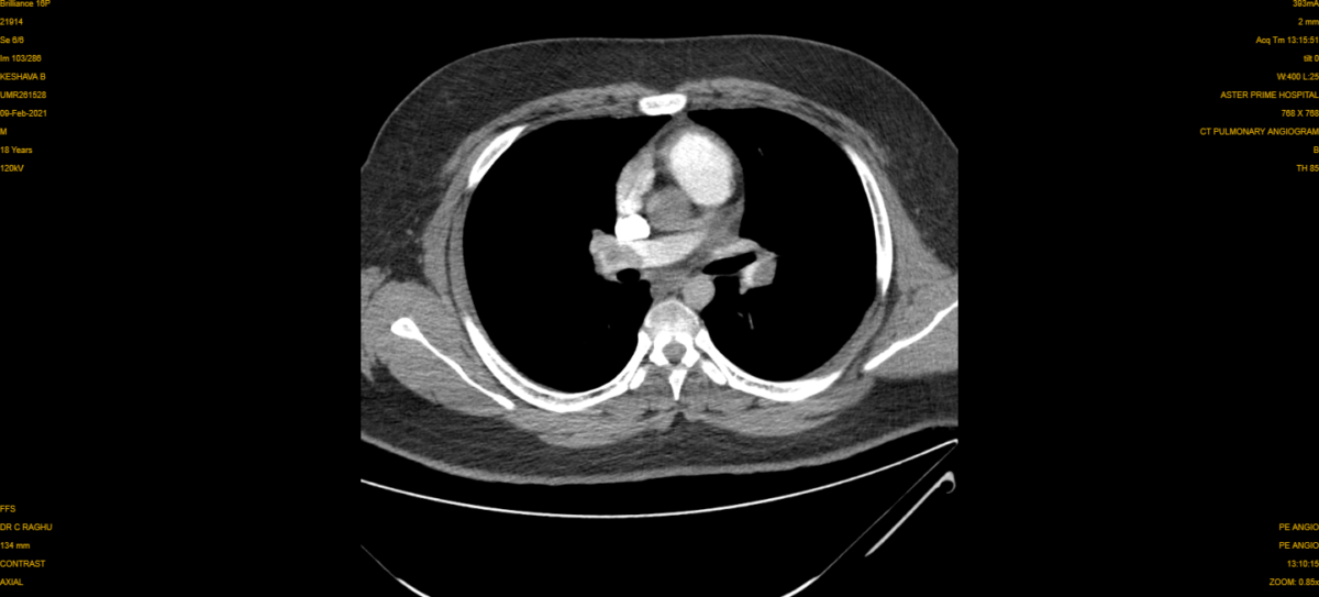 Pulmonary Embolism CT 2