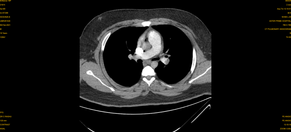 Pulmonary Embolism CT 3