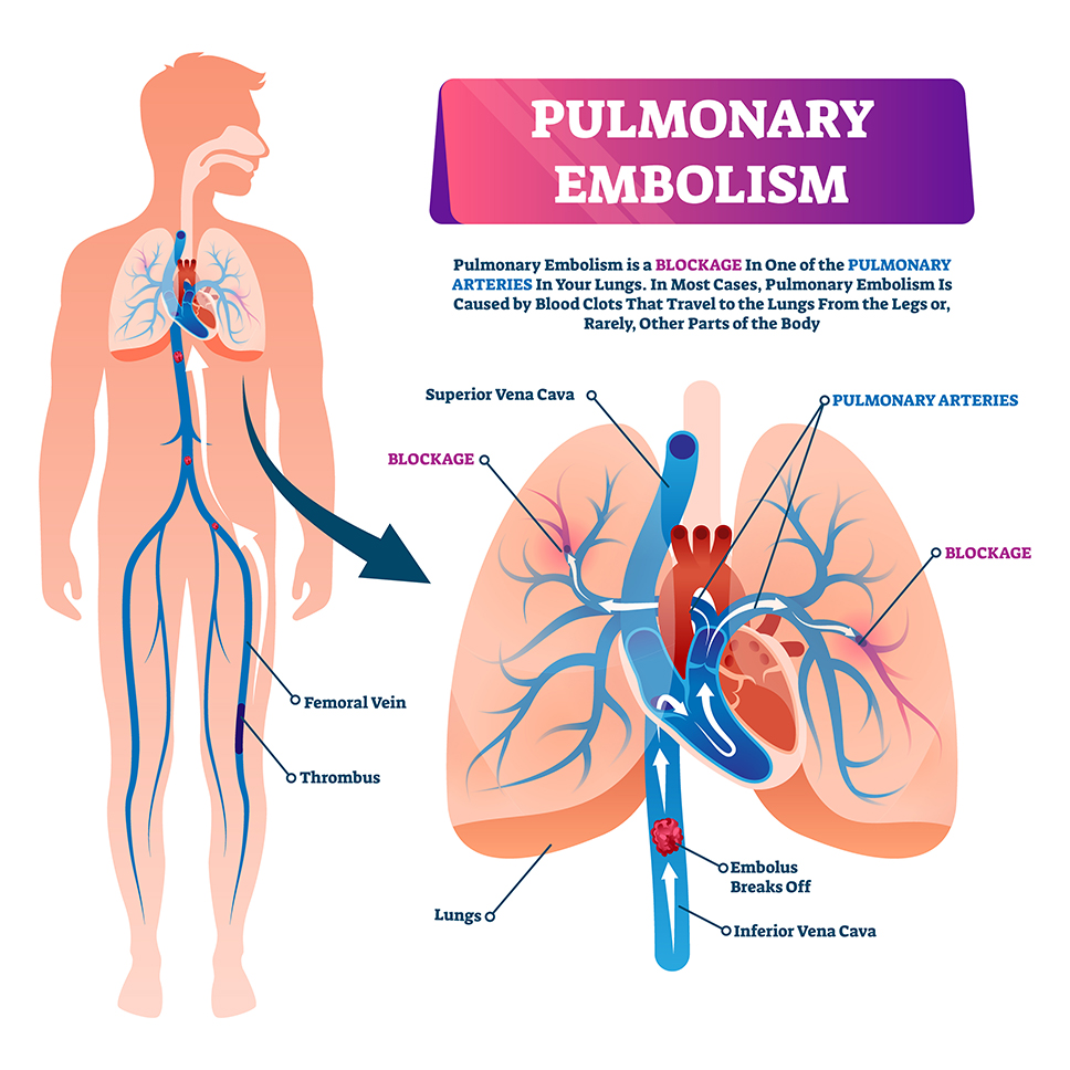 3 Biggest Risks of a Pulmonary Embolism 2