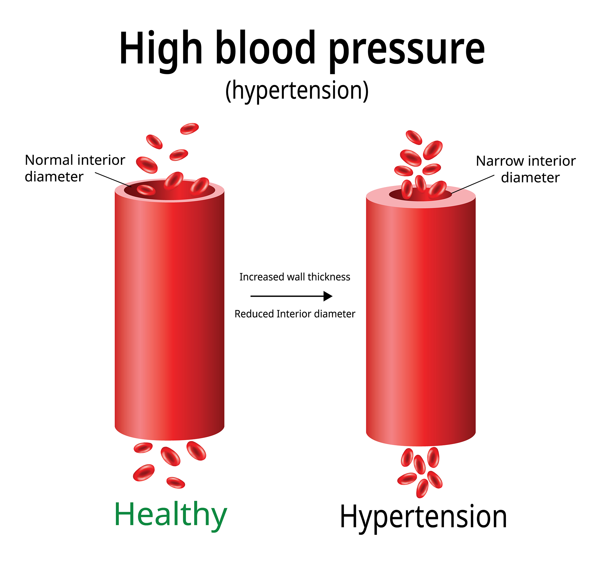 High Blood Pressure Hypertension 