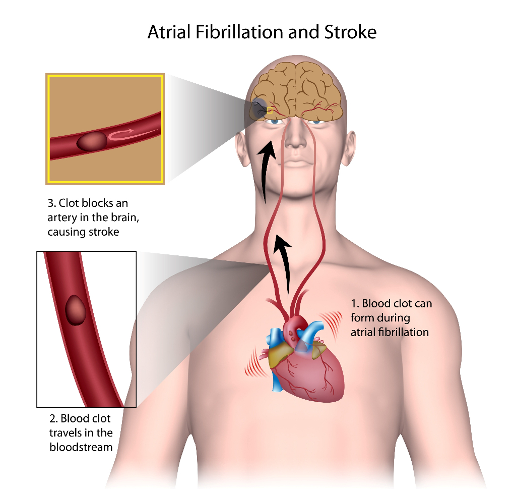 Atrial Fibrillation and stroke-1024