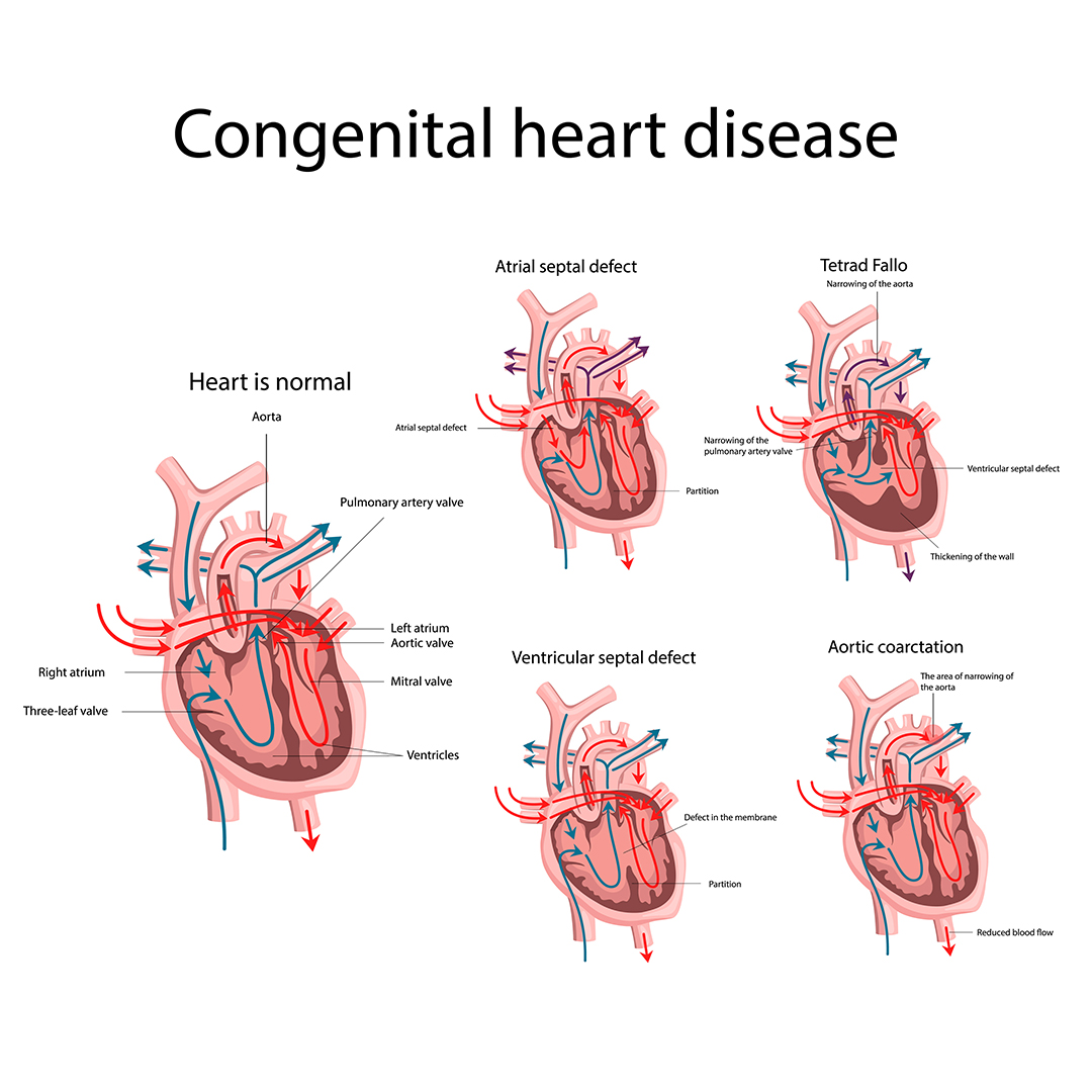 Congenital Heart Disease - Causes, Symptoms and Treatment | Dr Raghu