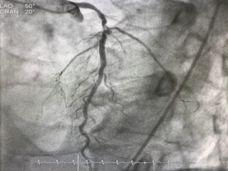 Coronary Bifurcation Lesions