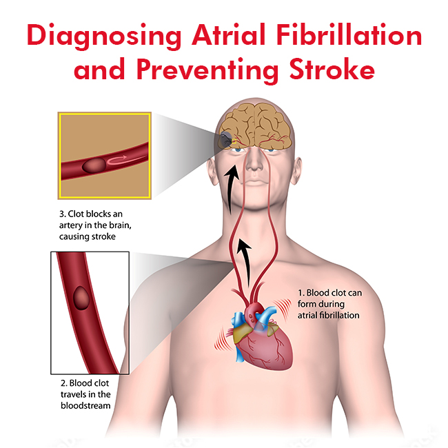 Diagnosing Atrial Fibrillation and Preventing Stroke