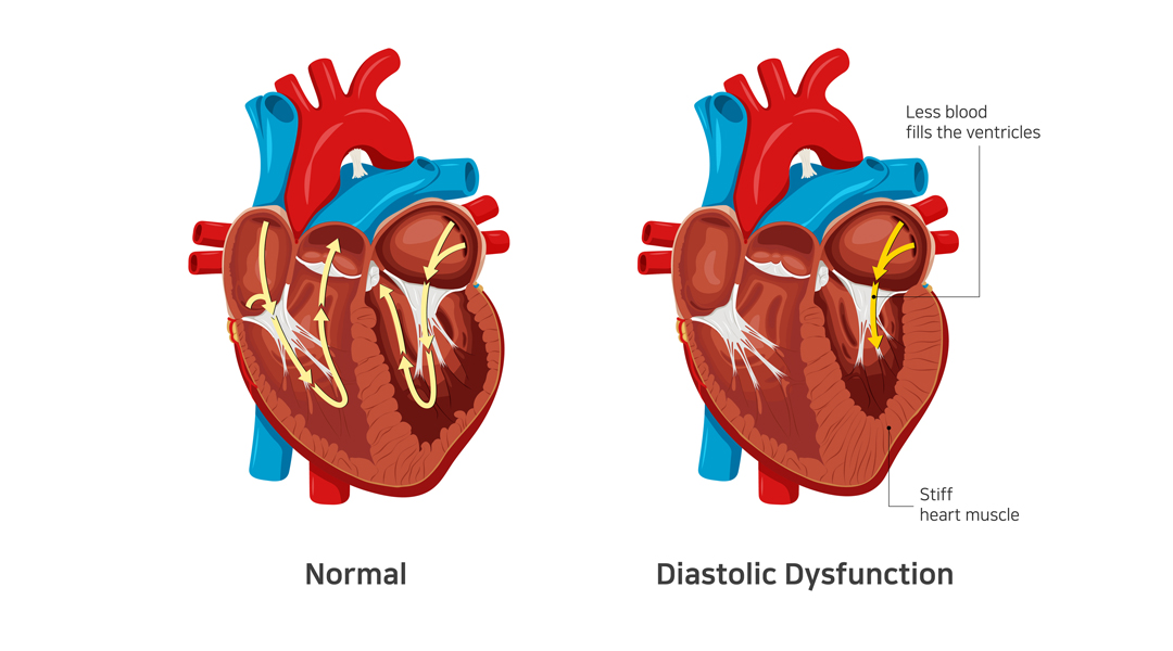 diastolic dysfunction