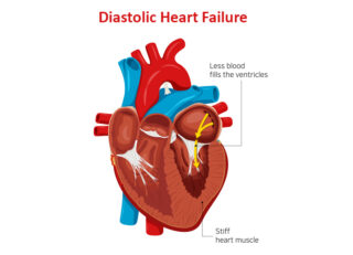 diastolic dysfunction