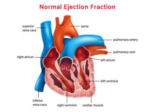 Normal Ejection Fraction