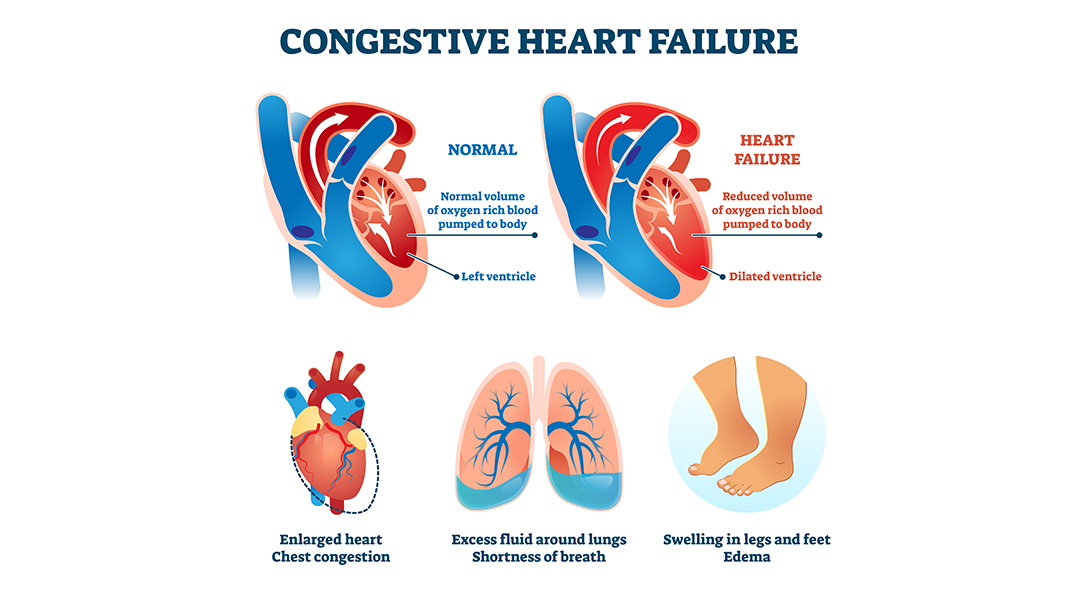 congestive cardiac failure