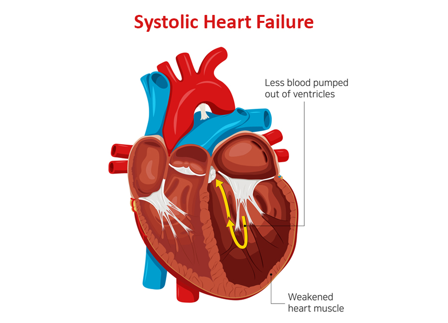 Systolic-heart-failure-img.jpg