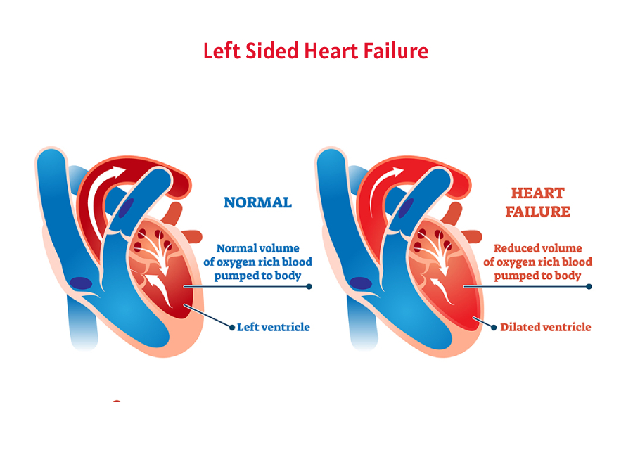 Left sided heart failure