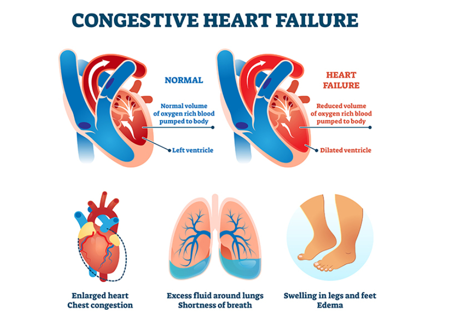 Diagnosing Congestive Heart Failure