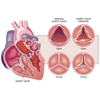aortic stenosis