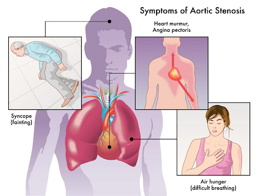 symptoms of Aortic Stenosis