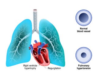 Pulmonary-Hypertension.jpg