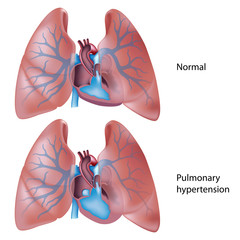 Pulmonary embolectomy