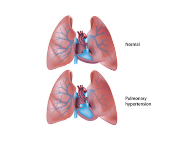 Pulmonary.jpg