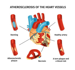Atherosclerosis