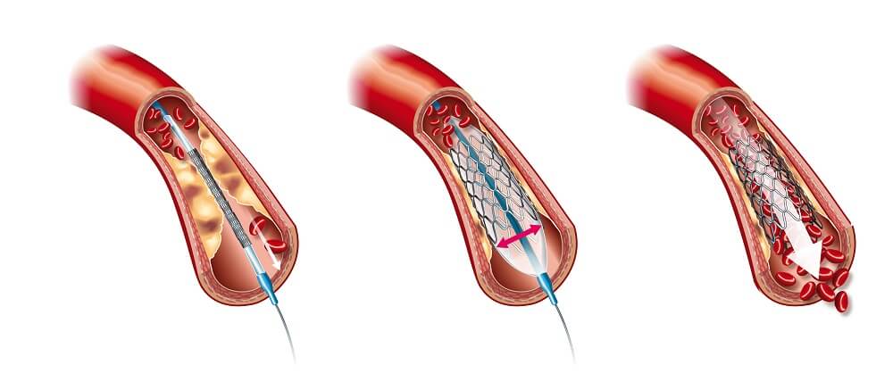 Angioplasty and Stent