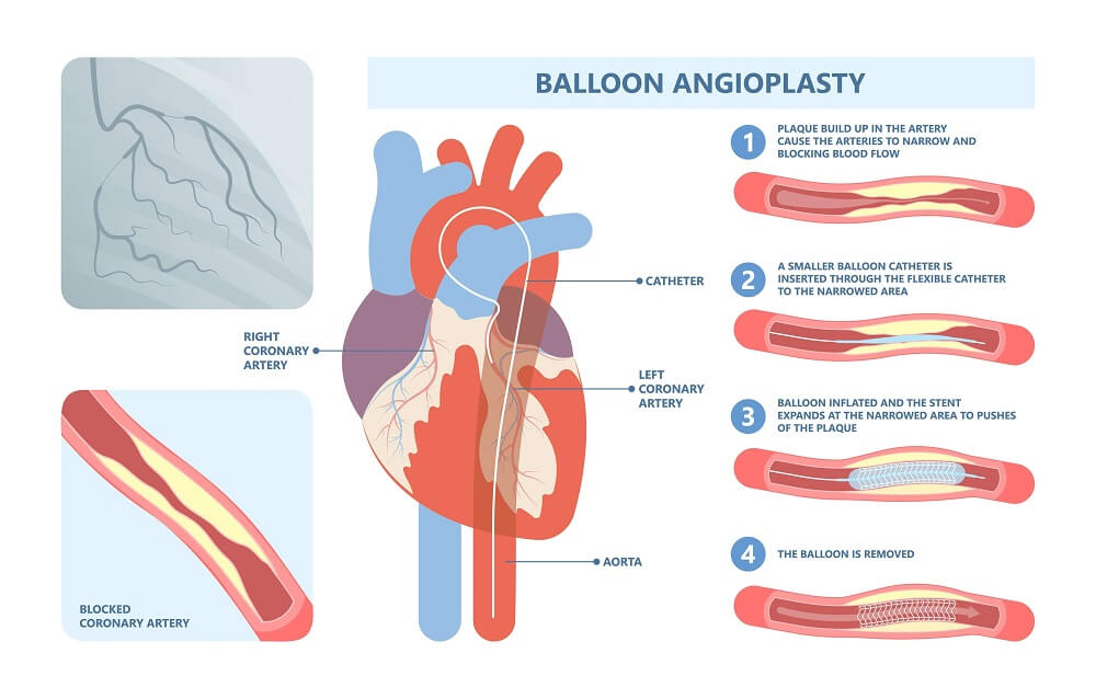 Angioplasty and Angiography