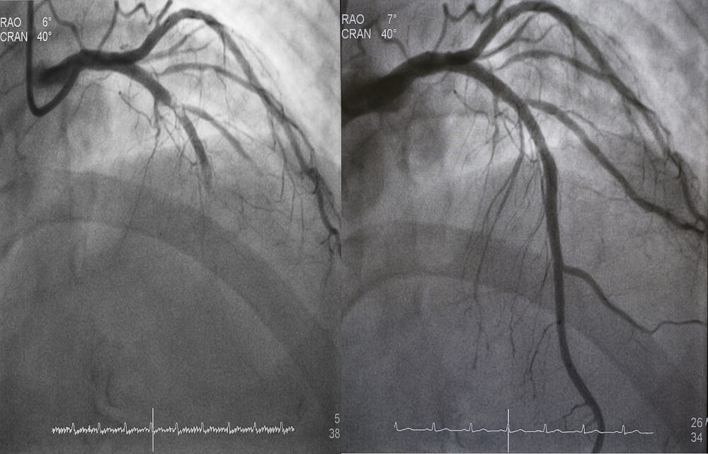 Coronary-Angioplasty-Procedure-After-a-Heart-Attack.jpeg