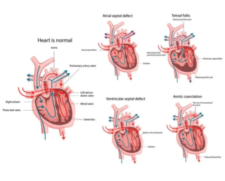 Congenital heart diseases