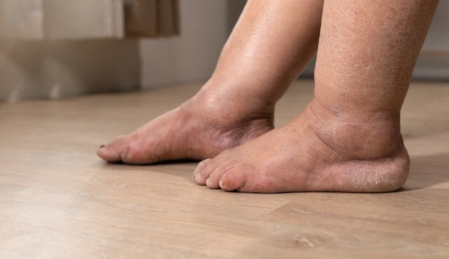 Swelling in feet and legs