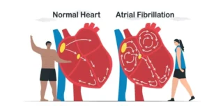 atrial fibrillation treatment