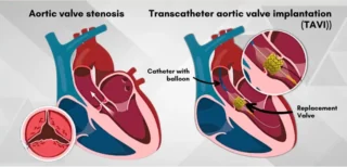 TAVI expert in India