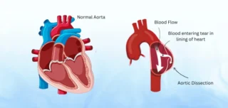 Aortic Dissection