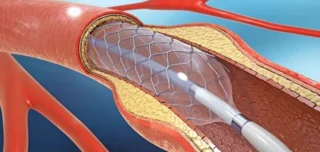 Angioplasty Expert in India