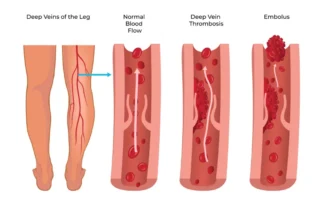Deep Vein Thrombosis