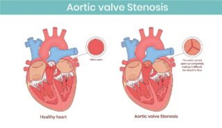 Aortic Stenosis