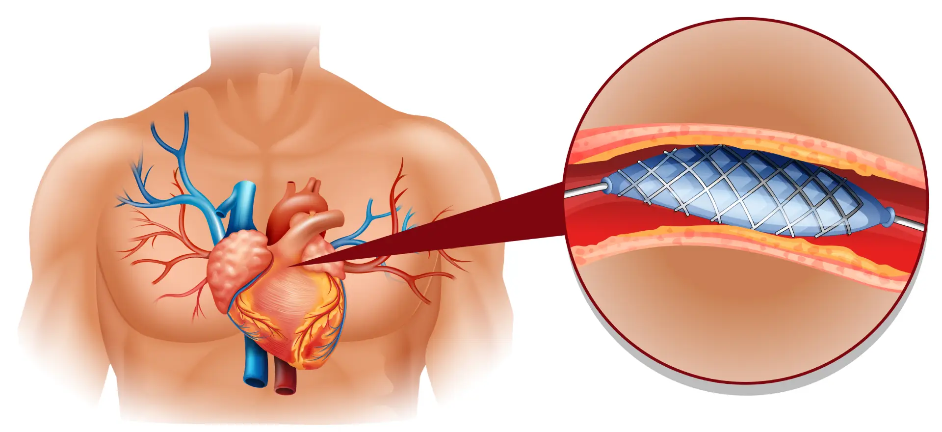 TAVR expert in India