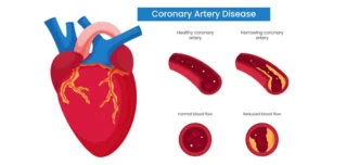 coronary artery disease