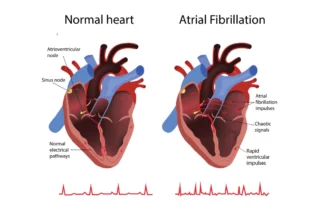 Atrial Fibrillation