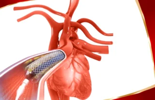 Chip Angioplasty