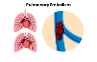 Pulmonary Embolism Treatment