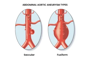 Abdominal Aortic Aneurysm Types